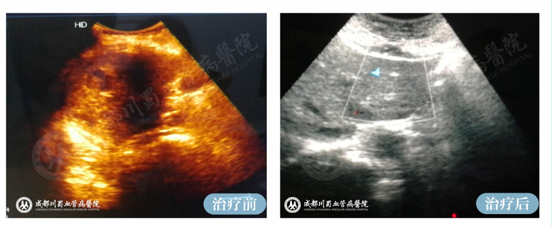 肝血管瘤对比2.jpg