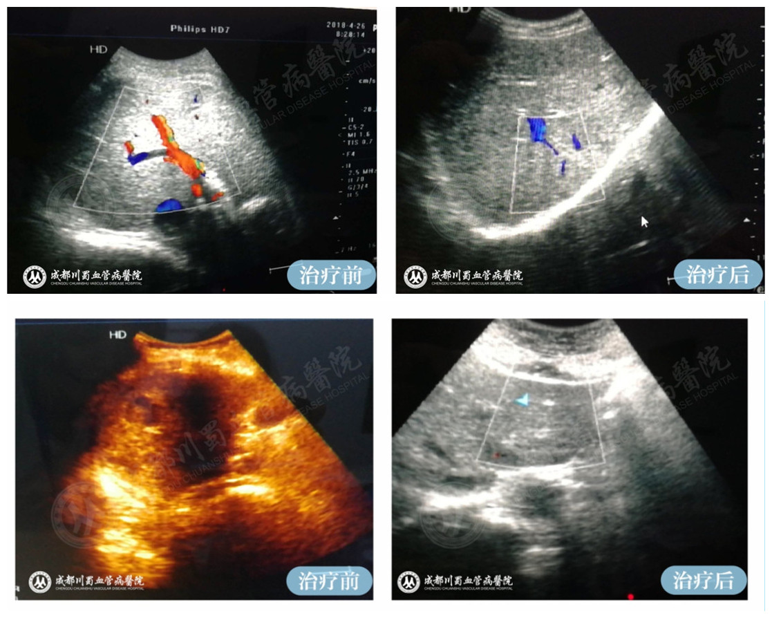 【成都血管瘤治疗案例】智能腔内综合治疗前后对比12.jpg