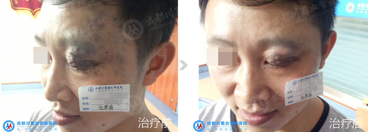 【成都海绵状血管瘤治疗案例】智能腔内综合治疗前后对比.jpg